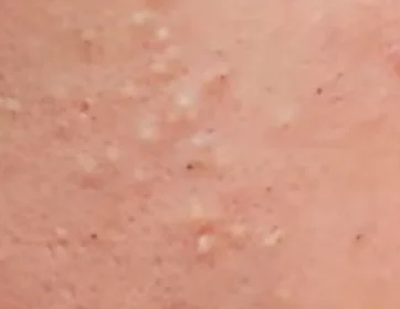 comedonal acne