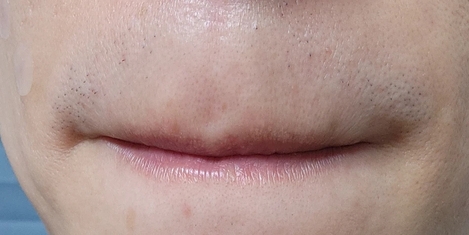 남자 수염 제모 17회차 후기 (클라리티2 레이저) - The mens grooming 남자 수염 제모 17회차 후기 (클라리티2 레이저) - The Mens Grooming