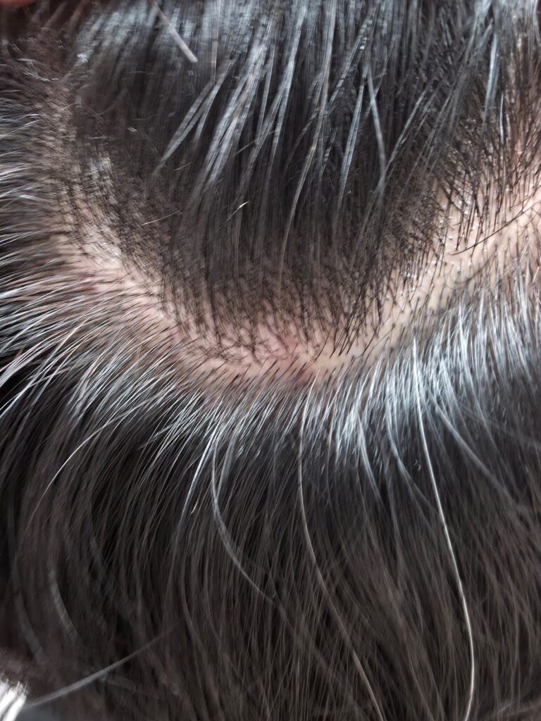 붉은 염증이 보이는 두피