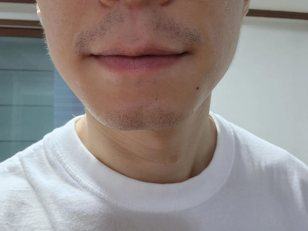 1. 아포지 레이저로 수염 제모 (2회차 앞두고) (1)