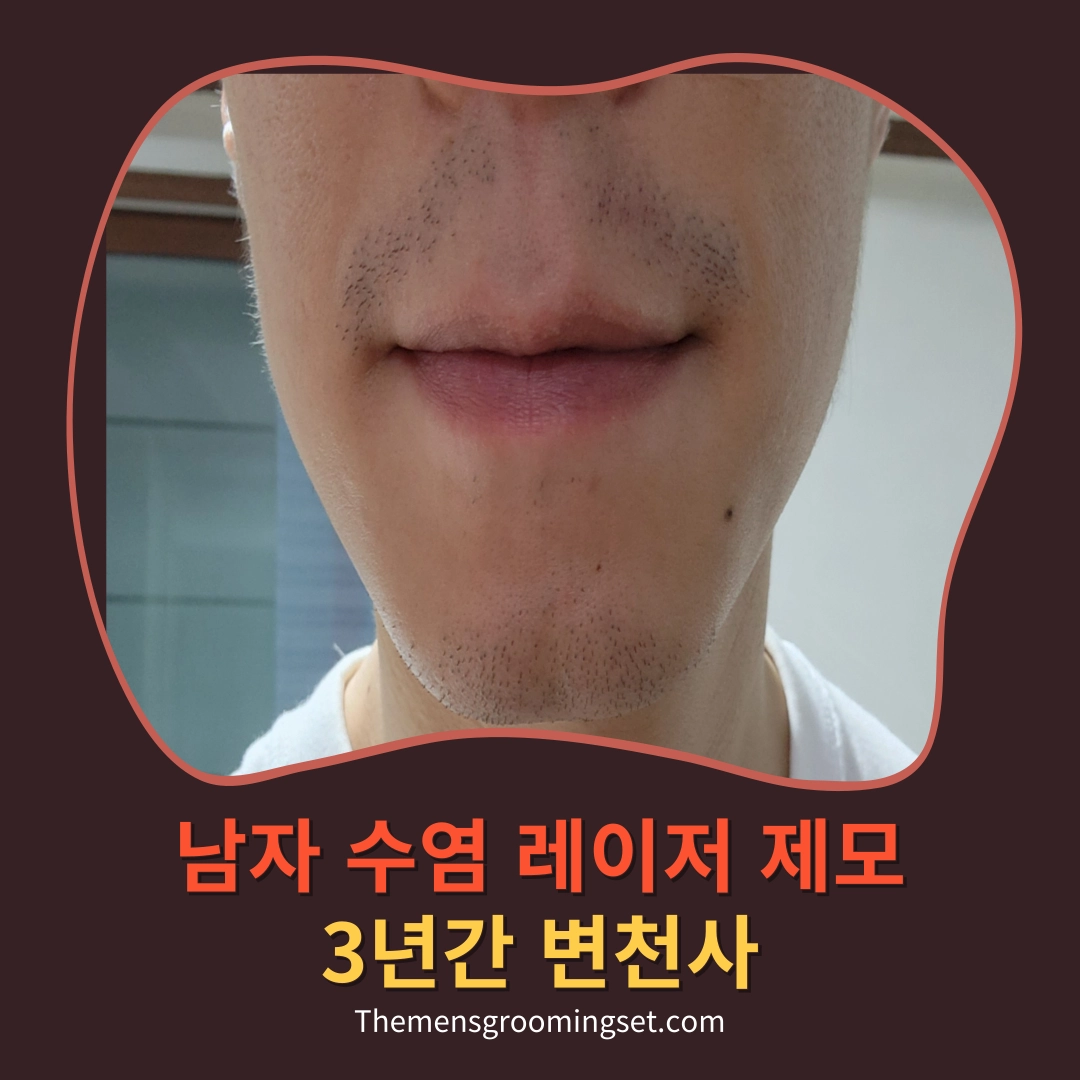 남자 수염 레이저 제모 대표 이미지