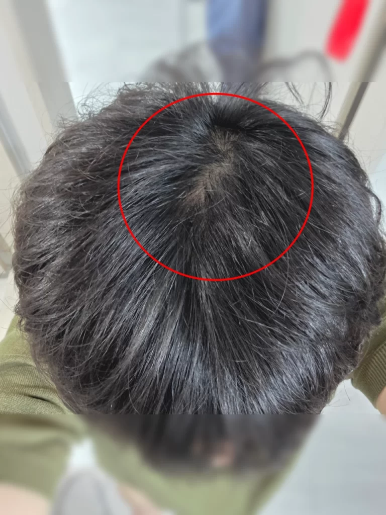 두타윈 5개월 차 정수리 근황