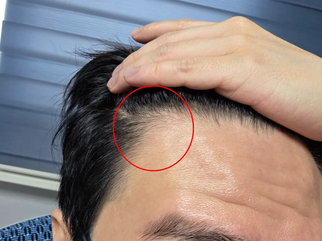 잔머리가 난 M자 부위 2